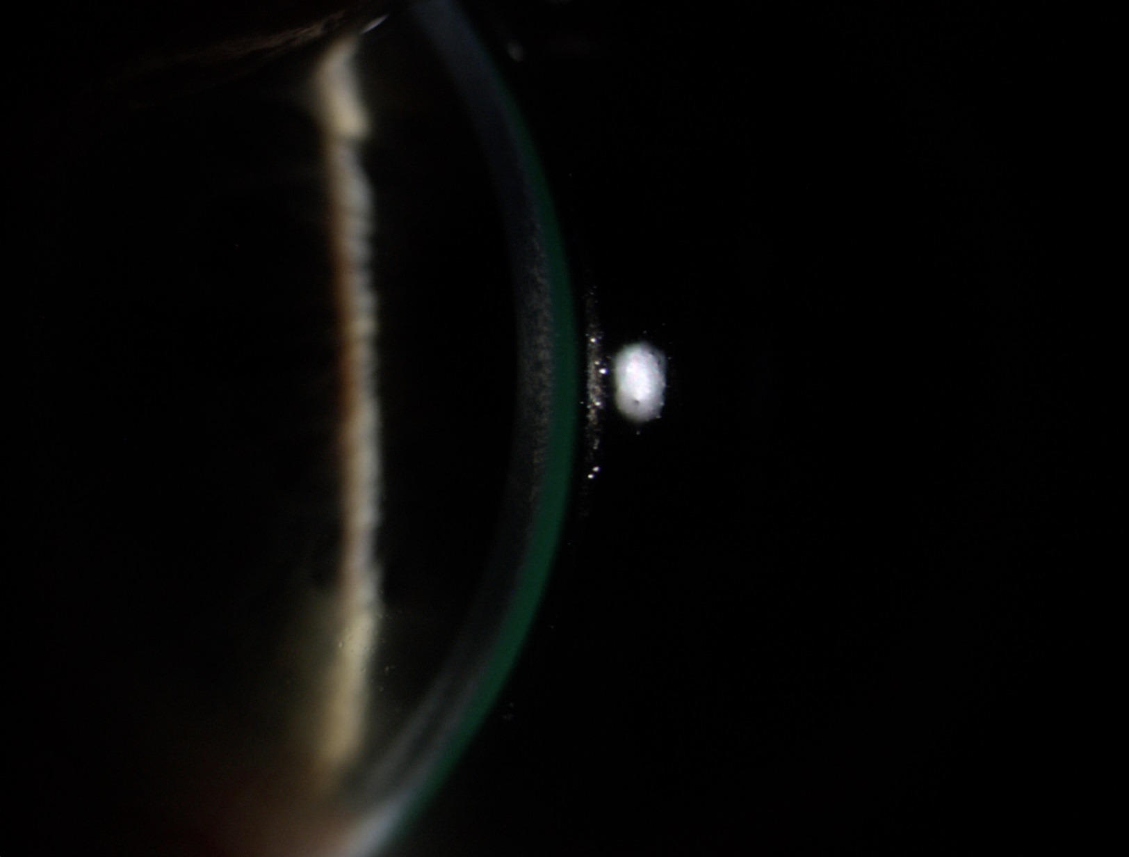 Illumination When Assessing With the Slit Lamp